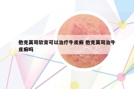 他克莫司软膏可以治疗牛皮癣 他克莫司治牛皮癣吗