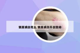 银屑病会死么 银屑病会不会致命