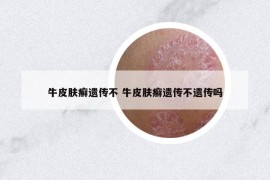 牛皮肤癣遗传不 牛皮肤癣遗传不遗传吗