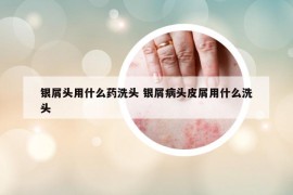 银屑头用什么药洗头 银屑病头皮屑用什么洗头
