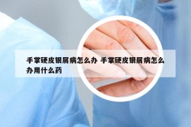 手掌硬皮银屑病怎么办 手掌硬皮银屑病怎么办用什么药