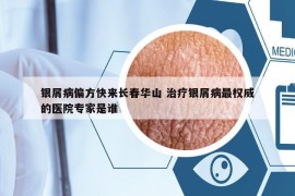 银屑病偏方快来长春华山 治疗银屑病最权威的医院专家是谁
