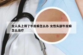 女人头上得了牛皮癣怎么办 女性头部牛皮癣怎么治疗