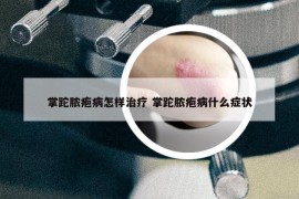 掌跎脓疱病怎样治疗 掌跎脓疱病什么症状