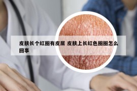 皮肤长个红圈有皮屑 皮肤上长红色圈圈怎么回事