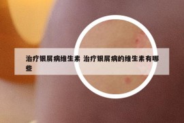 治疗银屑病维生素 治疗银屑病的维生素有哪些