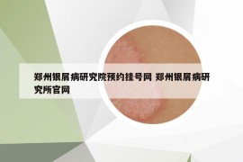 郑州银屑病研究院预约挂号网 郑州银屑病研究所官网