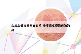 头皮上长皮癣能自愈吗 治疗银皮癣最有效的药