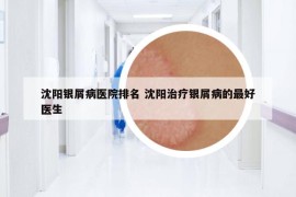 沈阳银屑病医院排名 沈阳治疗银屑病的最好医生