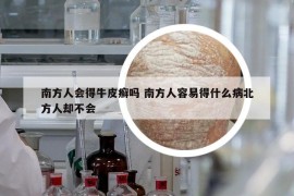 南方人会得牛皮癣吗 南方人容易得什么病北方人却不会