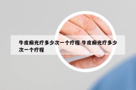 牛皮癣光疗多少次一个疗程 牛皮癣光疗多少次一个疗程