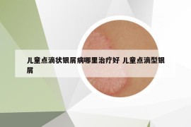 儿童点滴状银屑病哪里治疗好 儿童点滴型银屑