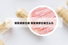 银屑病脊柱痛 银屑病脊柱痛怎么办