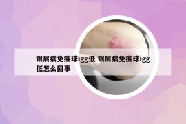 银屑病免疫球igg低 银屑病免疫球igg低怎么回事