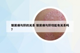 银屑病与肝的关系 银屑病与肝功能有关系吗?