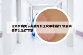 治银屑病关节炎最好的医院哪家最好 银屑病关节炎治疗专家
