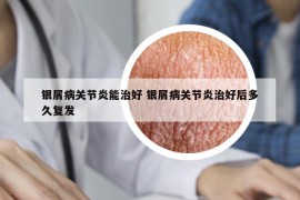 银屑病关节炎能治好 银屑病关节炎治好后多久复发