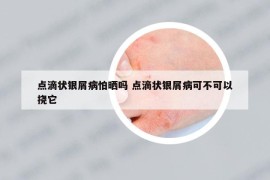 点滴状银屑病怕晒吗 点滴状银屑病可不可以挠它
