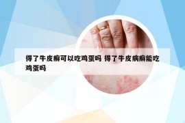 得了牛皮癣可以吃鸡蛋吗 得了牛皮病癣能吃鸡蛋吗
