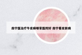 南宁医治疗牛皮癣哪家医院好 南宁看皮肤病