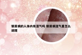 银屑病的人体内有湿气吗 银屑病湿气重怎么调理