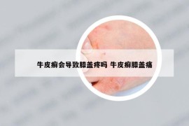 牛皮癣会导致膝盖疼吗 牛皮癣膝盖痛
