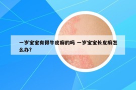 一岁宝宝有得牛皮癣的吗 一岁宝宝长皮癣怎么办?