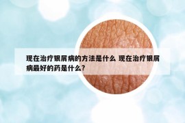 现在治疗银屑病的方法是什么 现在治疗银屑病最好的药是什么?