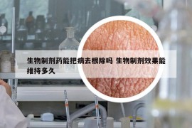 生物制剂药能把病去根除吗 生物制剂效果能维持多久