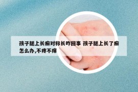 孩子腿上长癣对称长咋回事 孩子腿上长了癣怎么办,不疼不痒