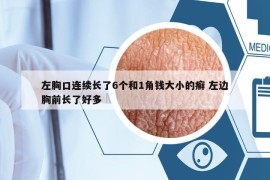 左胸口连续长了6个和1角钱大小的癣 左边胸前长了好多