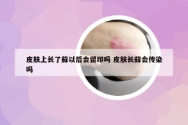 皮肤上长了藓以后会留印吗 皮肤长藓会传染吗