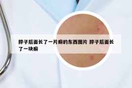 脖子后面长了一片癣的东西图片 脖子后面长了一块癣
