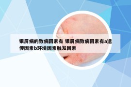 银屑病的致病因素有 银屑病致病因素有a遗传因素b环境因素触发因素