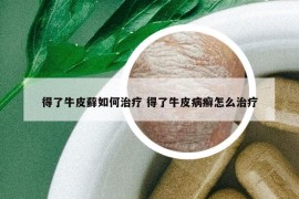 得了牛皮藓如何治疗 得了牛皮病癣怎么治疗