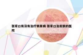 张家口有没有治疗银屑病 张家口治皮肤的医院