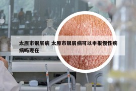 太原市银屑病 太原市银屑病可以申报慢性疾病吗现在