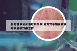 复方甘草苷片治疗银屑病 复方甘草酸苷胶囊对银屑病效果怎样