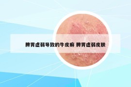 脾胃虚弱导致的牛皮癣 脾胃虚弱皮肤