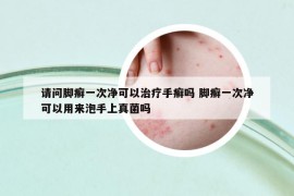 请问脚癣一次净可以治疗手癣吗 脚癣一次净可以用来泡手上真菌吗