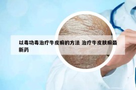 以毒功毒治疗牛皮癣的方法 治疗牛皮肤癣最新药