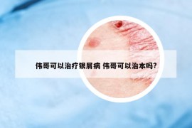 伟哥可以治疗银屑病 伟哥可以治本吗?