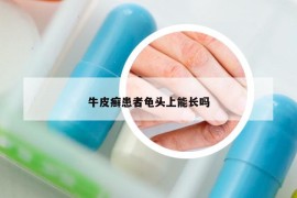 牛皮癣患者龟头上能长吗