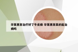 华莱黑茶治疗好了牛皮癣 华莱黑茶真的能治病吗