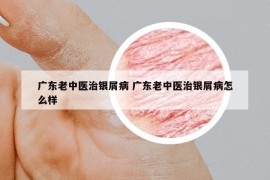 广东老中医治银屑病 广东老中医治银屑病怎么样