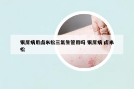 银屑病用卤米松三氯生管用吗 银屑病 卤米松