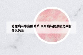 糖尿病与牛皮癣关系 银屑病与糖尿病之间有什么关系