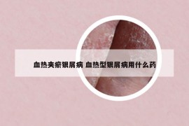 血热夹瘀银屑病 血热型银屑病用什么药