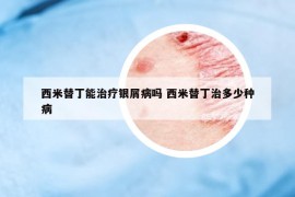 西米替丁能治疗银屑病吗 西米替丁治多少种病