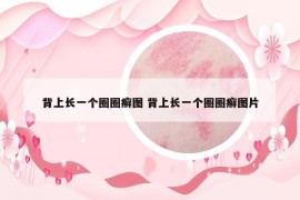 背上长一个圈圈癣图 背上长一个圈圈癣图片
